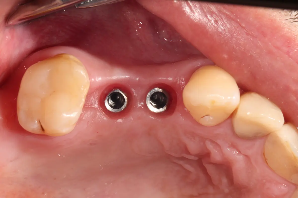 Eingeheilte Implantate nach externem Sinuslift – Freilegung vor Kronenversorgung