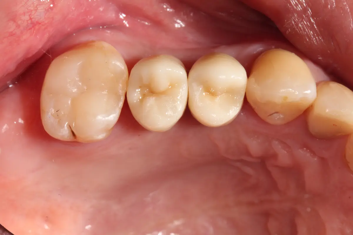 Fertige Keramikkronen auf Implantaten nach Sinuslift – Ergebnis der Versorgung