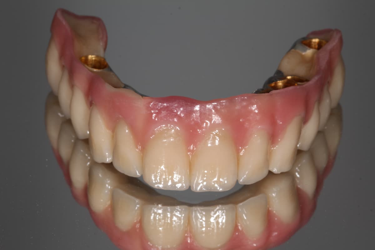 Herausnehmbare Brücke (Konus-Galvano) auf Implantaten