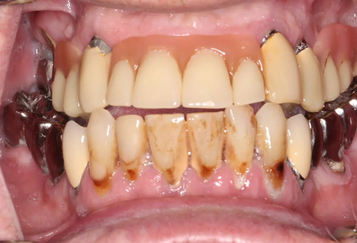 Intraoralbefund frontal