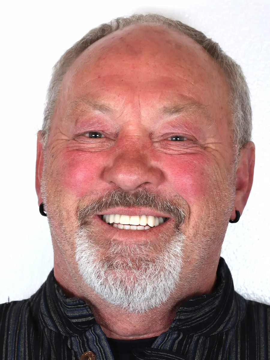 Gerhard — Ergebnis nach All-on-6 und All-on-4