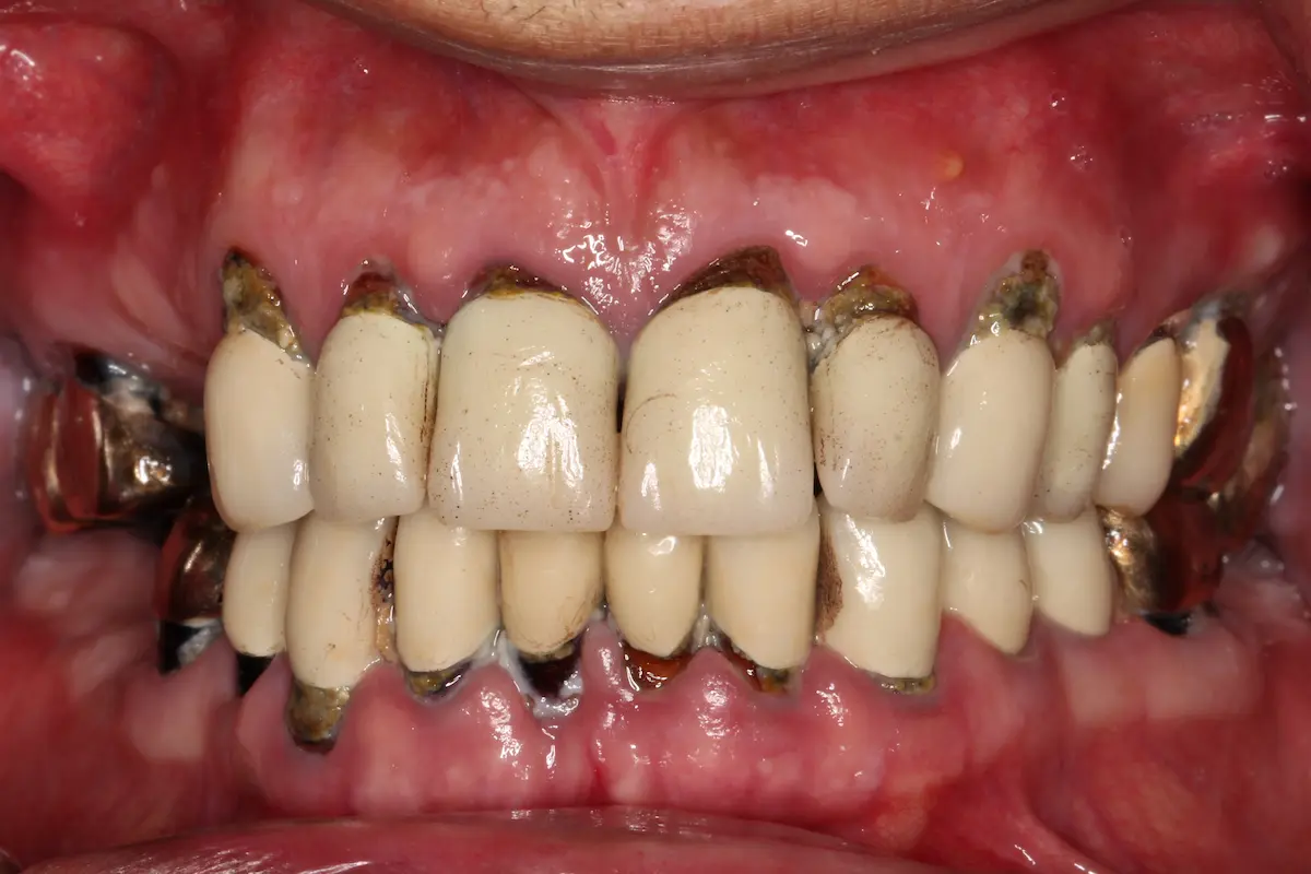 Intraoralbefund vor der Behandlung
