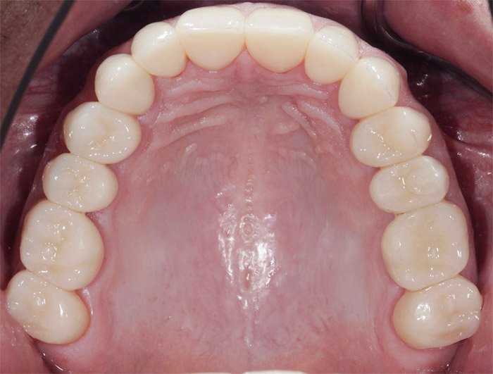 Behandlungsschritt Vollkeramik-Krone Dr. Vogtner