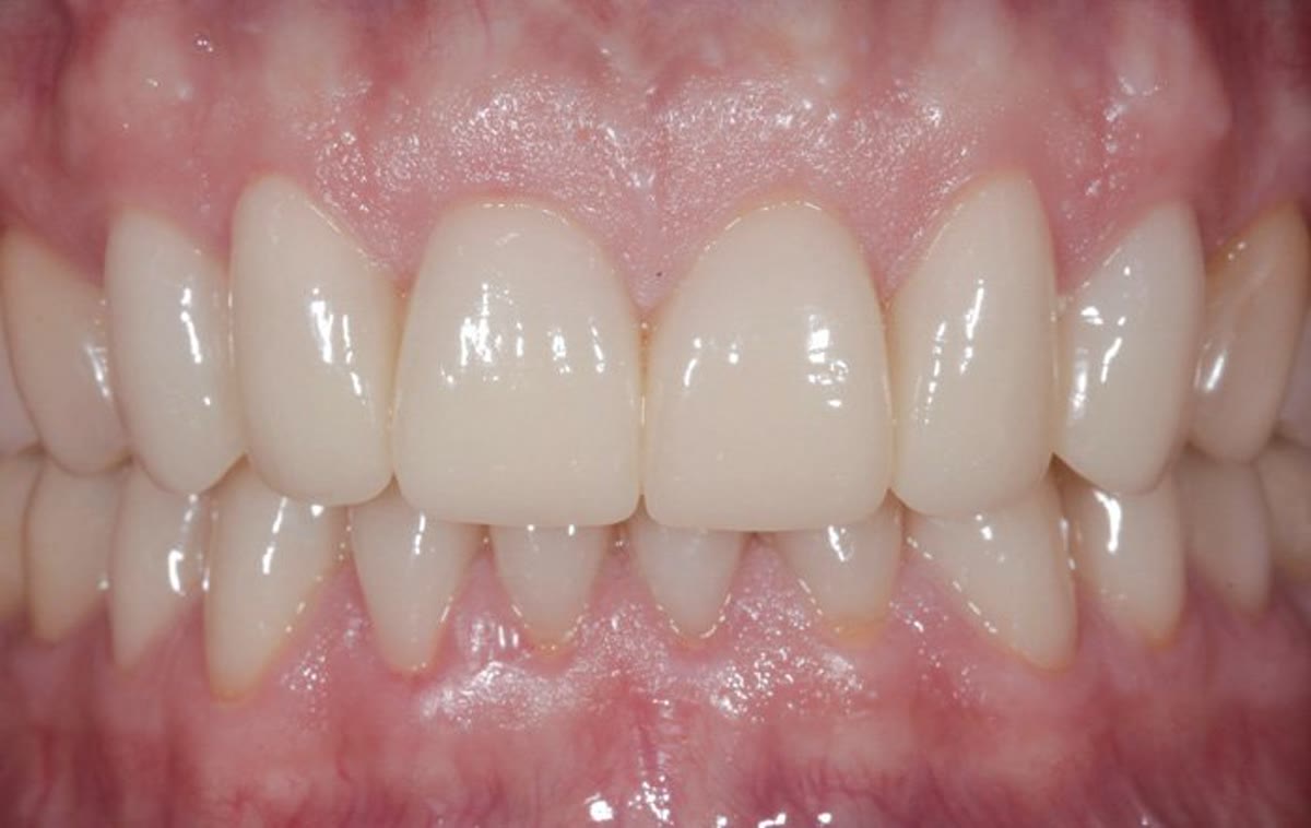 Nachher: Vollkeramikkronen