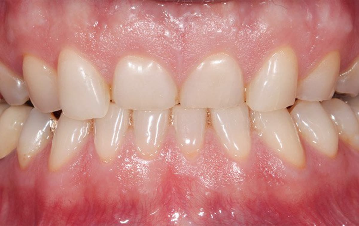 Vorher: Abgeknirscht Zähne