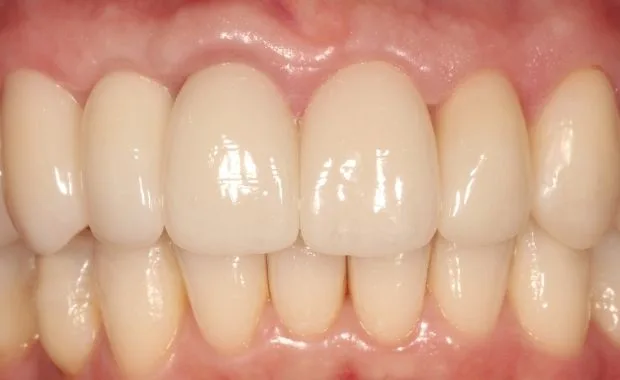 Nachher: Smile Design: Vollkeramikkronen + Sofortimplantat