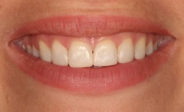 Nachher: Diastema-Schluss mit Komposit nach KFO