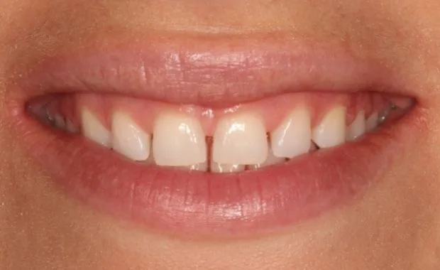 Vorher: Diastema-Schluss mit Komposit nach KFO