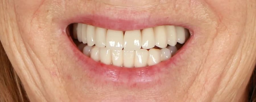 Ergebnis: implantatgetragene Vollversorgung bei Dr. Vogtner Ingolstadt