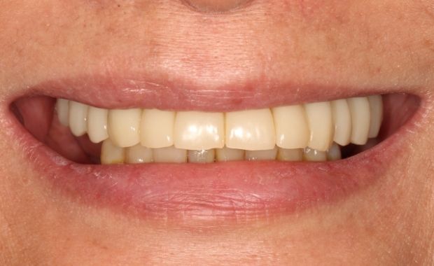 Ergebnis: herausnehmbare Brücke auf Implantaten (Konus-Galvano)