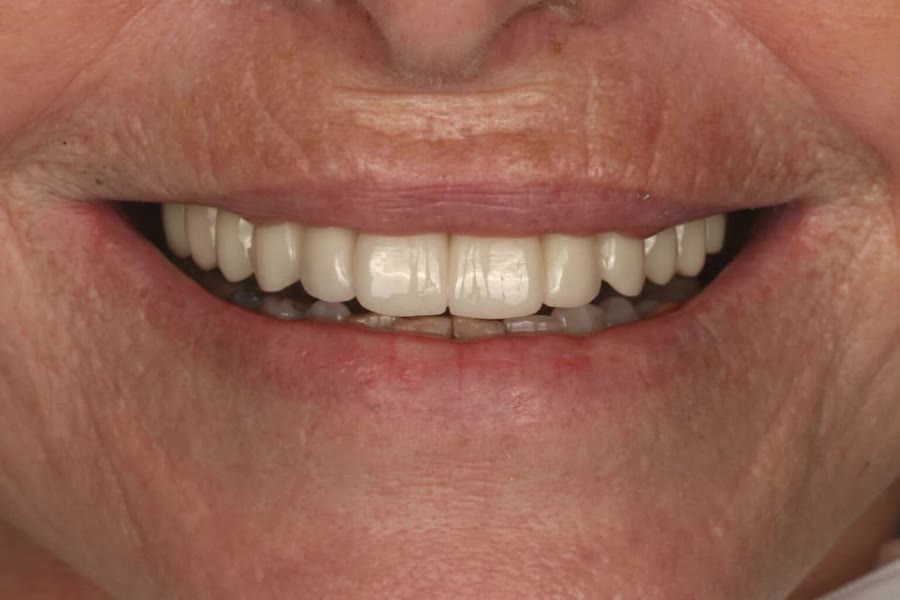 Nachher: Feste Zähne an einem Tag