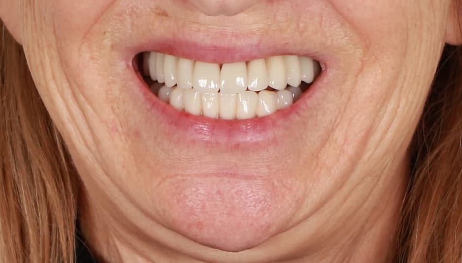 Nachher: Neue Kronen, Rezessionsdeckung, natürliches Lächeln