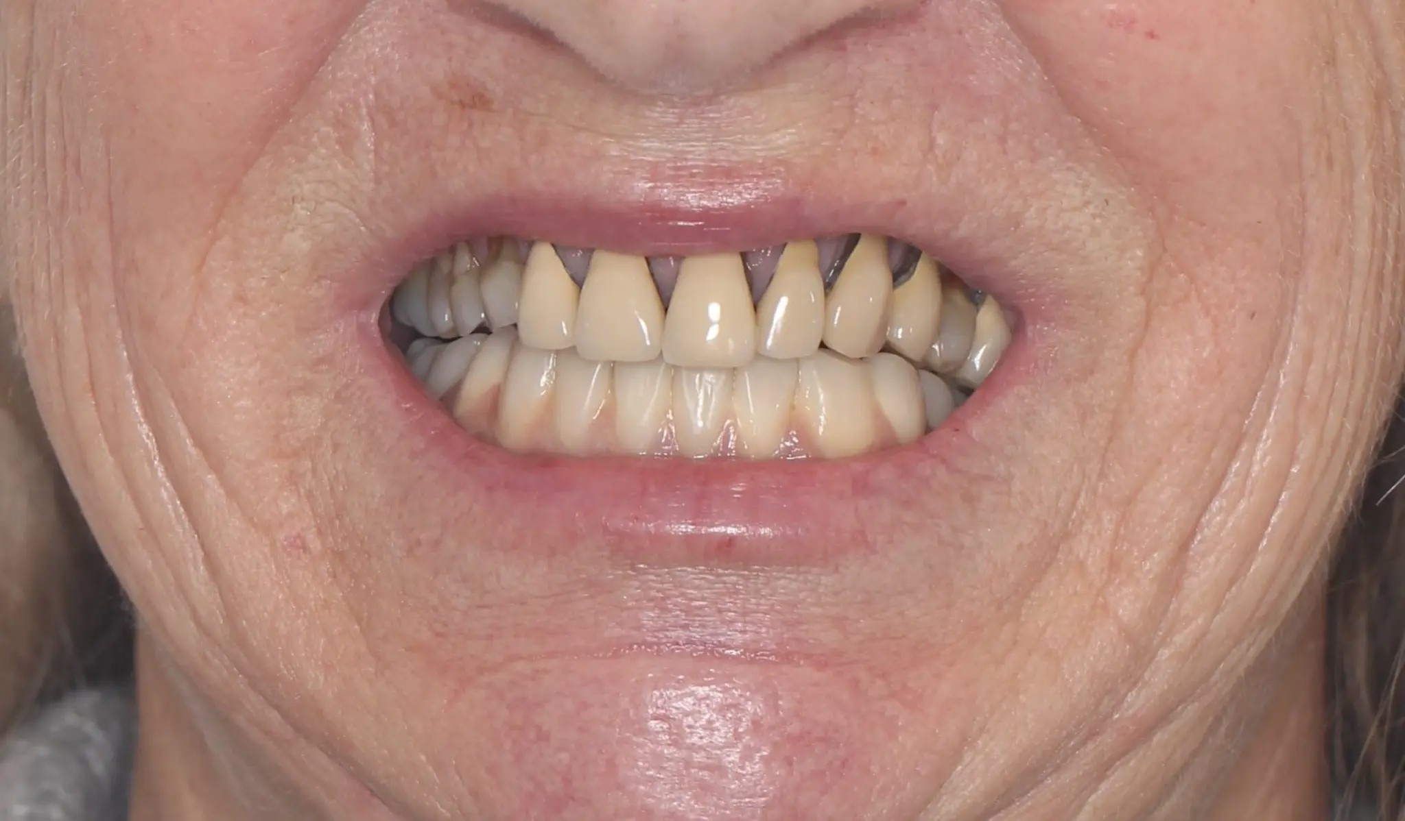 Vorher: Oberkiefer mit altem Zahnersatz, Rezessionen