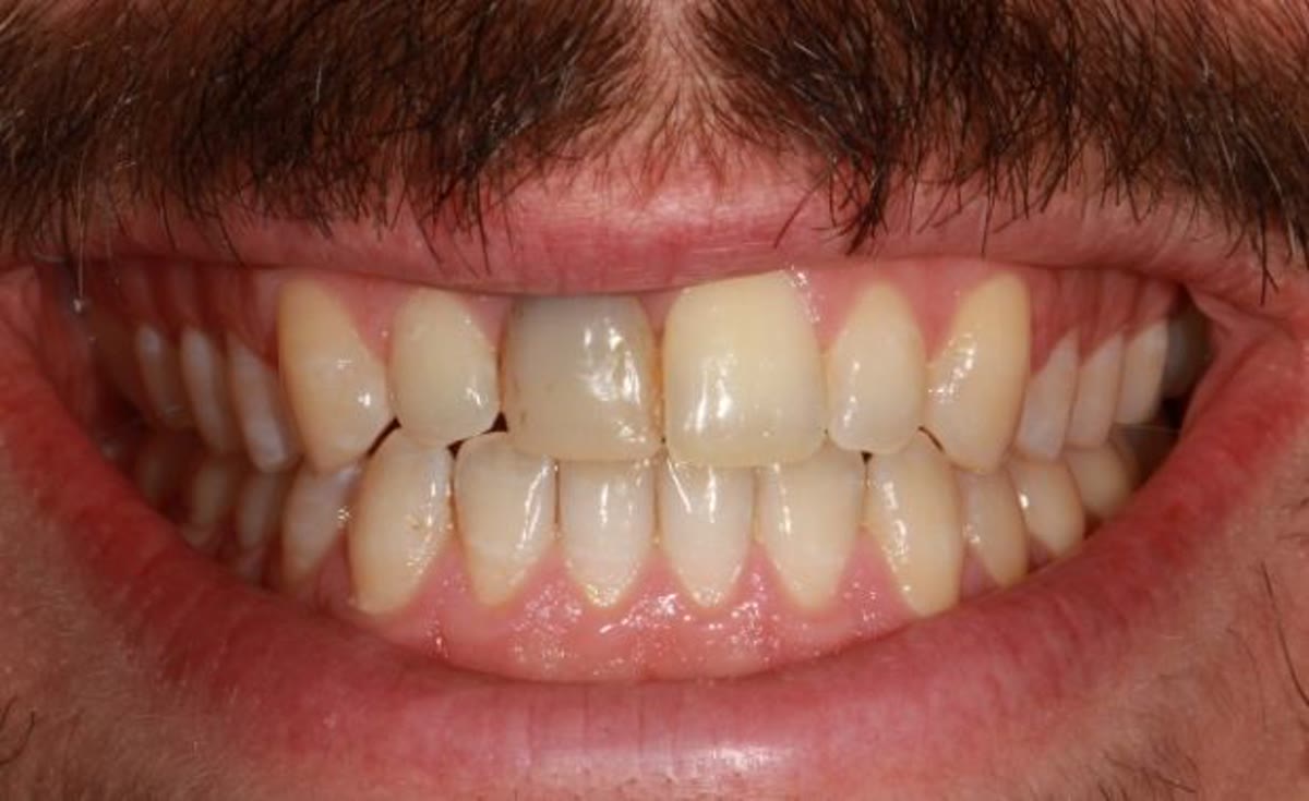 Vorher: Sofortimplantat nach Unfall