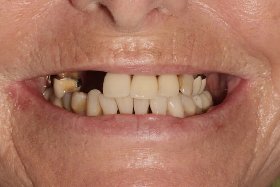 Vorher: Feste Zähne an einem Tag